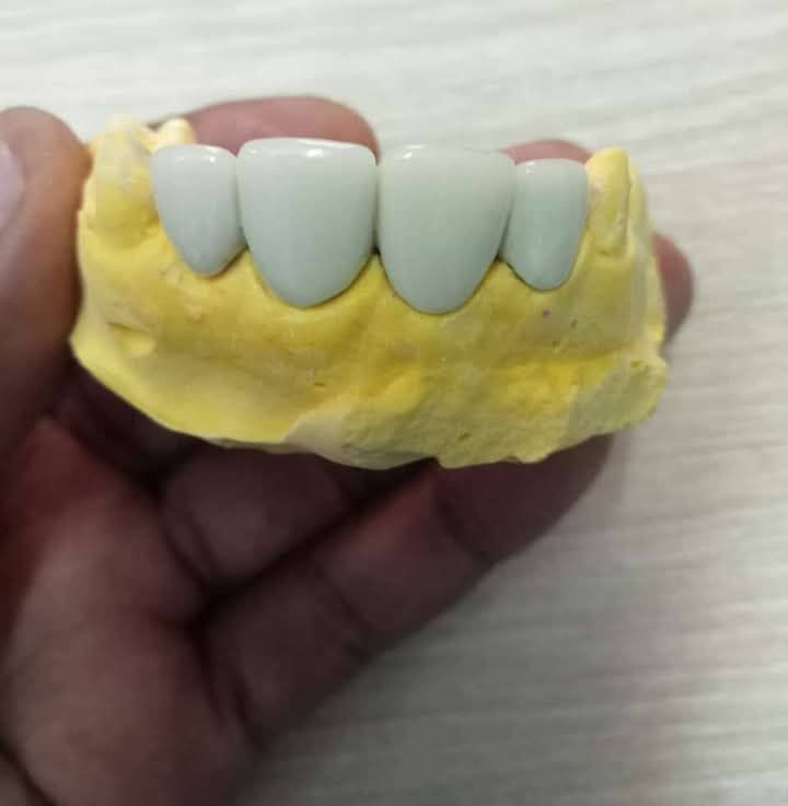 Crown & Bridge Treatment