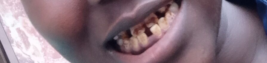 Before Teeth Whitening