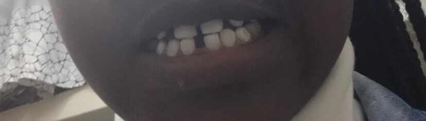 After Teeth Whitening